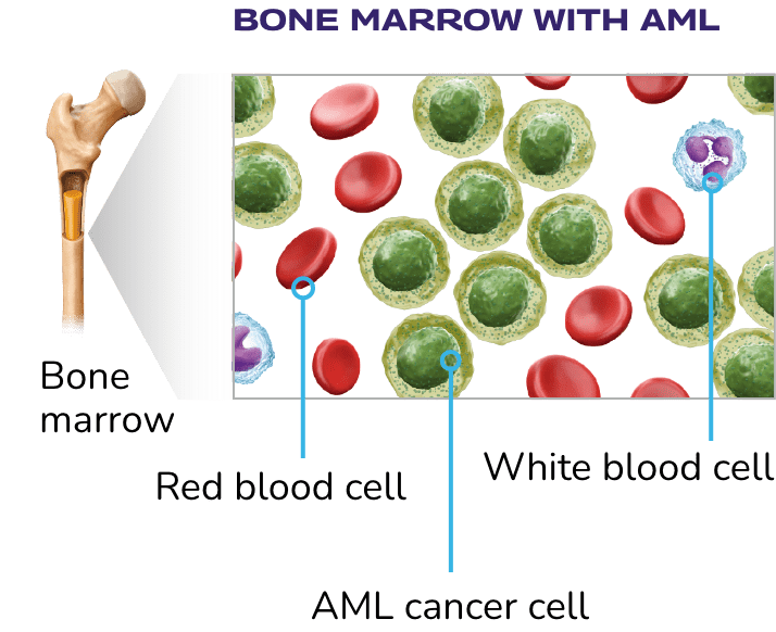 AML cancer cells forming with white blood cells and red blood cells in the bone marrow