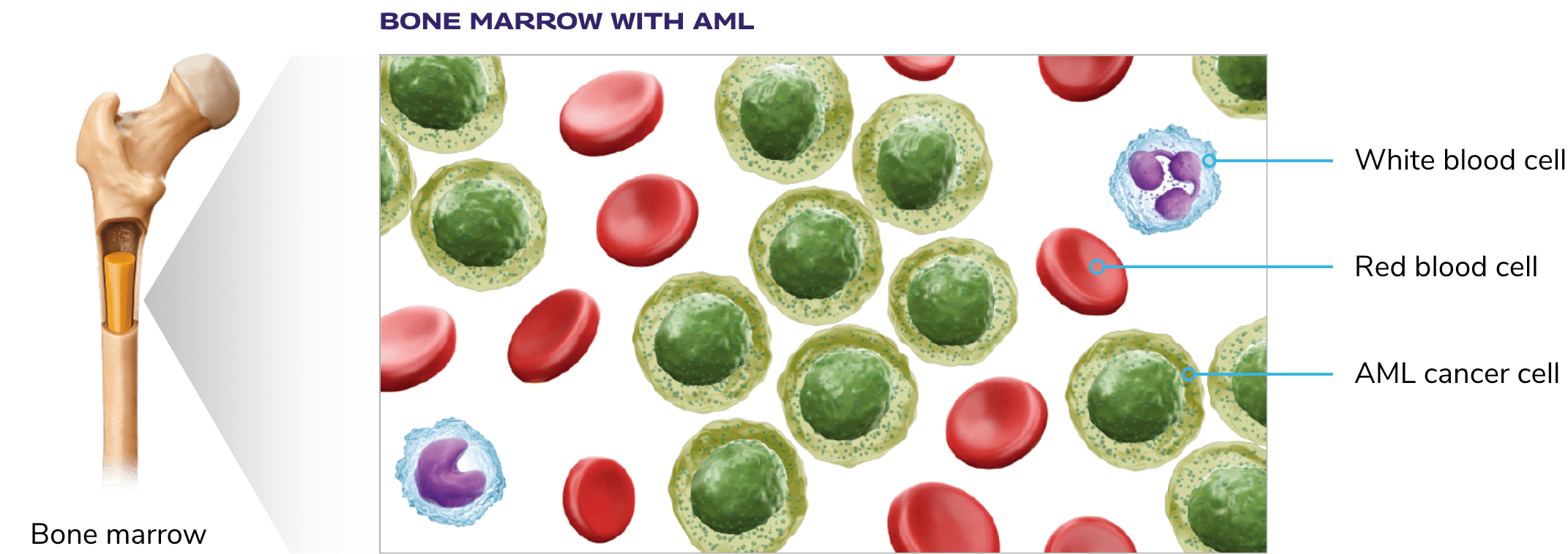 AML cancer cells forming with white blood cells and red blood cells in the bone marrow